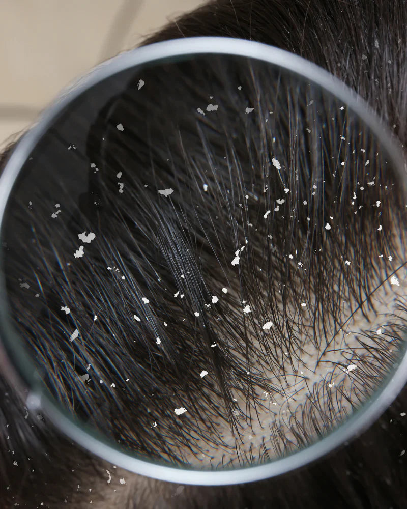 Dandruff removal